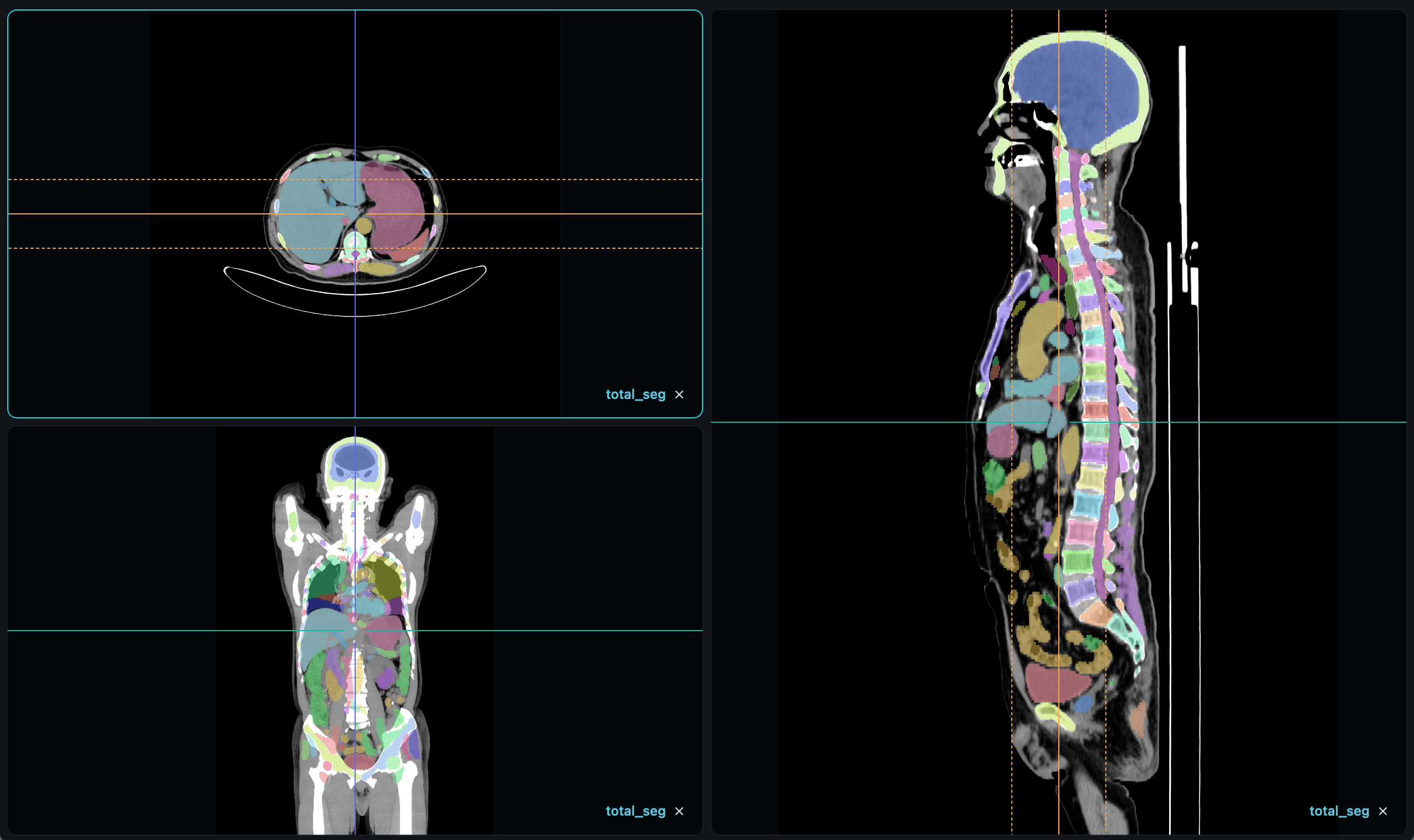 VisoRay MPR three-plane view with positioning lines and segmentation overlay